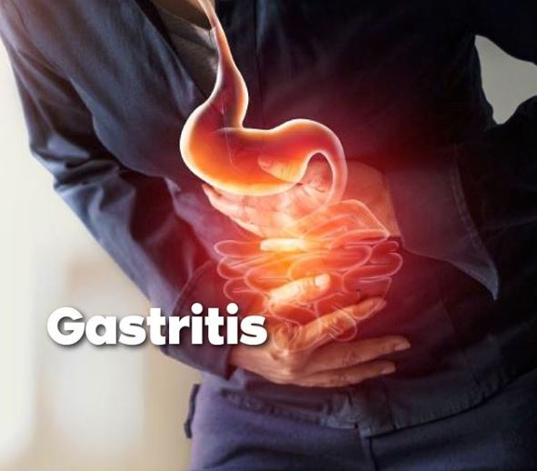 La gastritis es una inflamación de la mucosa gástric