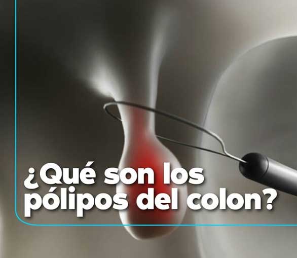 Pólipos Guayaquil
