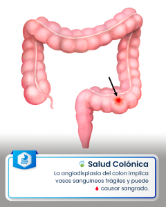 angiodisplasia del colon